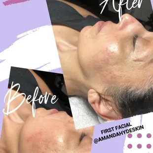 Before &amp; After of first facial with Amanda