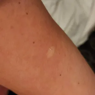 Bed Bug Bite and Rash