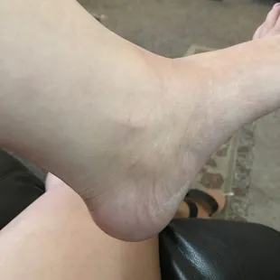 crushed feet, even though package promises a callous treatment