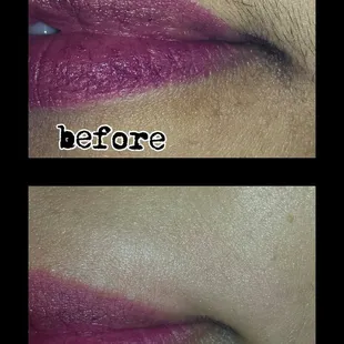 Most safe option for facial hair removal and lasts longer than wax!