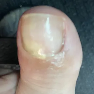 My toenail after a week of treatment. The red part around the toenail is painful.