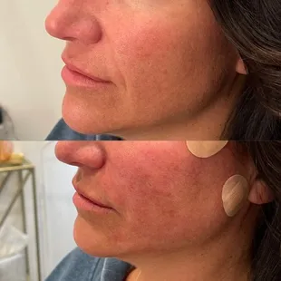 Lifting threads... bye nasolabial folds and jowls