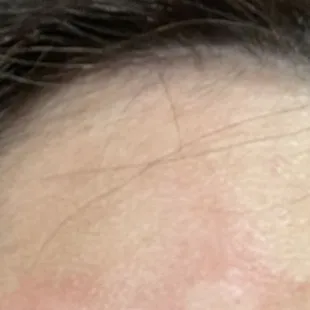3 bites on my eyebrow