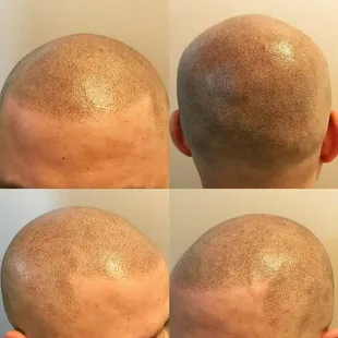 Scalp Micropigmentation