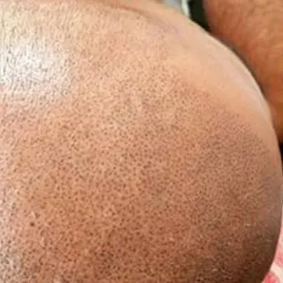 SMP Scalp Micropigmentation, healed