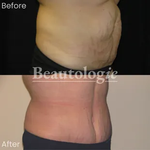 Tummy Tuck Before and After by Dr. James Knoetgen