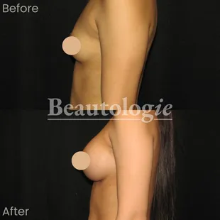 Bilateral Breast Augmentation with 400ml Saline Implants Before and After by Dr. James Knoetgen