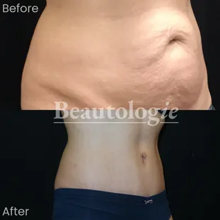 Tummy Tuck Before and After by Dr. James Knoetgen