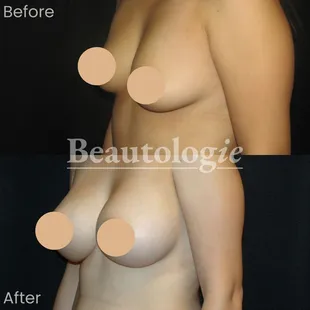 Bilateral Breast Augmentation with 400ml Saline Implants Before and After by Dr. James Knoetgen
