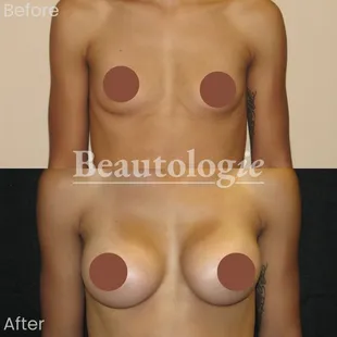 Bilateral Breast Augmentation with 350ml Saline Implants Before and After by Dr. James Knoetgen