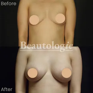 Bilateral Breast Augmentation with 400ml Saline Implants Before and After by Dr. James Knoetgen