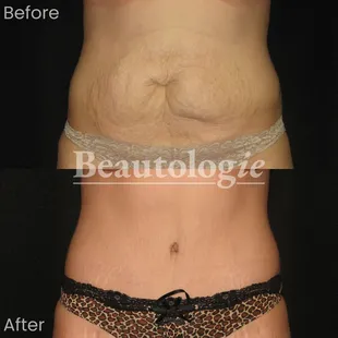 Tummy Tuck Before and After by Dr. James Knoetgen