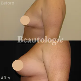 Bilateral Breast Augmentation with 400ml Saline Implants Before and After by Dr. James Knoetgen