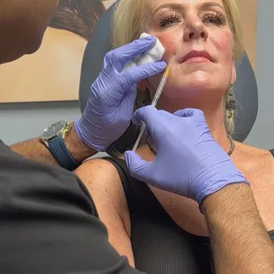 Sculptra of the Face