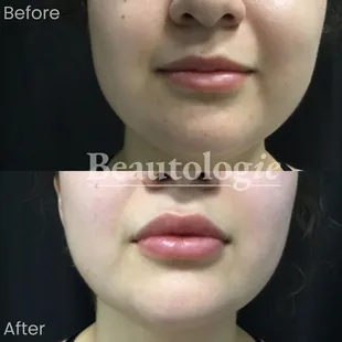 Lip Fillers 1cc Restylane Defyne Before and After by Dr. Milan Shah