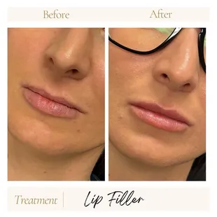 Lip filler
