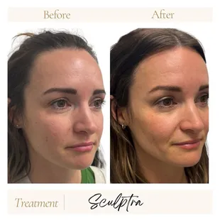 Sculptra with one session