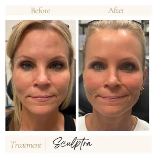 Sculptra with one session