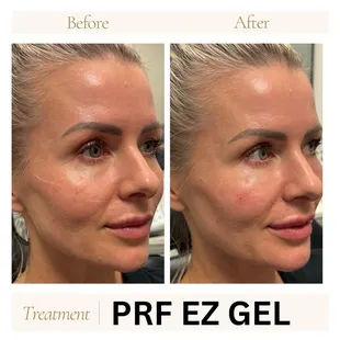PRF gel under eyes - 100% natural treatment