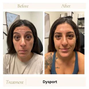 Dysport for wrinkle relaxing