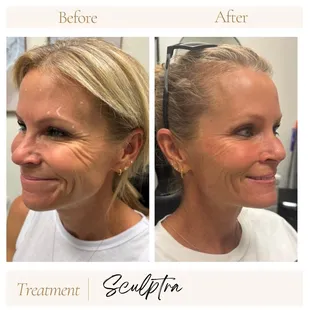 Sculptra with one session