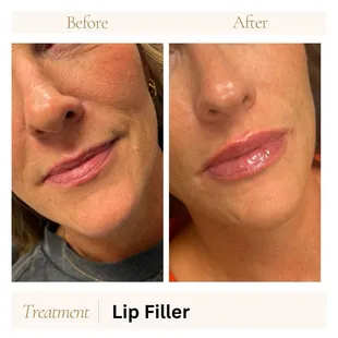 Lip filler