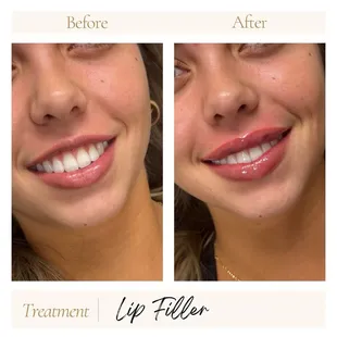 Lip filler