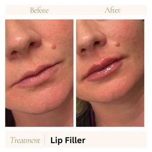 Lip filler
