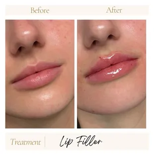 Lip filler