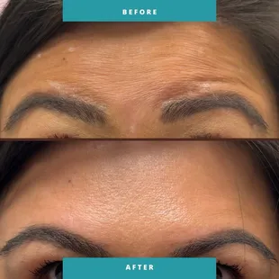 Jeuveau for wrinkle relaxing