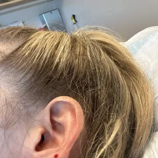 Got marked up for procedure.....