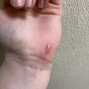 Pretty bad cut from the tube slide. Parents be warned.