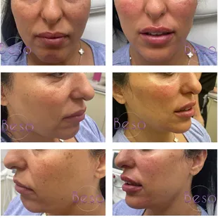 Liquid Face Lift treatment before &amp; after.