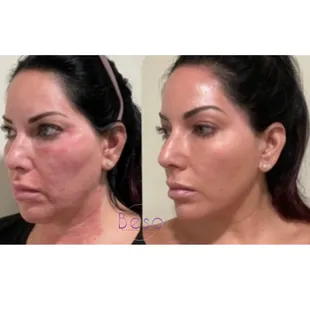 Venus Viva RF Micro-needling treatment before &amp; after 3 sessions.