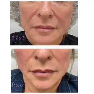 PDO Thread Lift before and after.