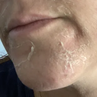 Perfect Derma Peel