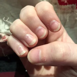 As you can see the purple indentions in ALL OF THE NAILS from over filing and shaving it down tooooo much.