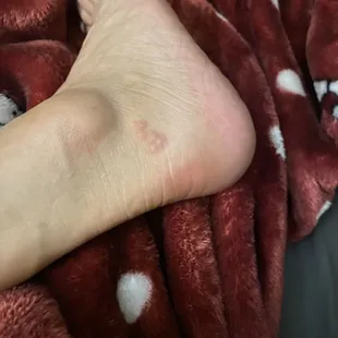 Bed bug bites