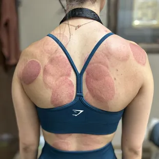 Cupping releases painful trigger points, improves blood and lymph circulation, relieves pain, promotes mobility and range of motion.