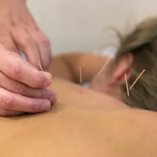 Acupuncture for upper back pain and chest congestion