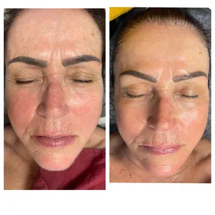 Wrinkles removed facial