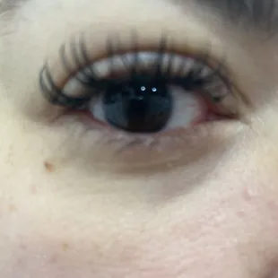Irritating red and burning from lash extensions.