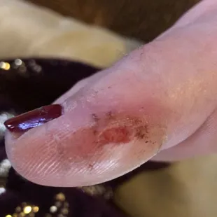 Poorly trained staff cut my toe.