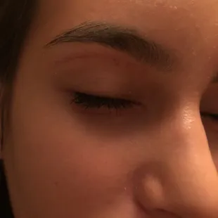Bruising/scarring under eye after 1 day.