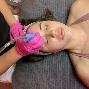 Hydro Dermabrasion
