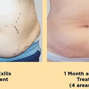 Before and After Exilis Photos