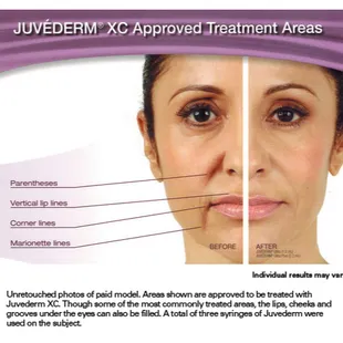 Area&apos;s Juvederm can treat