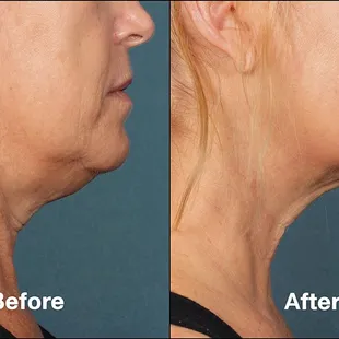 1 Exilis skin tightening for evey vial you buy. Kybella $499 per vial