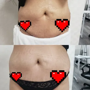 Cavitation/vaccum therapy/ Radio Frequency/laser lipo
