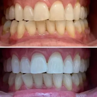 Teeth whitening